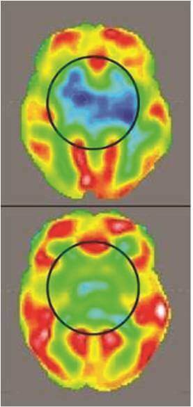 PET Scan 2 - Autism Treatment Before and after